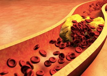 নতুন গবেষণা অনুযায়ী কোলেস্টেরল বা ডিমের উপস্থিতি স্ট্রোকের ঝুঁকি বাড়ায় না