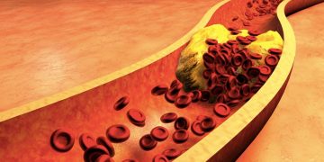 নতুন গবেষণা অনুযায়ী কোলেস্টেরল বা ডিমের উপস্থিতি স্ট্রোকের ঝুঁকি বাড়ায় না