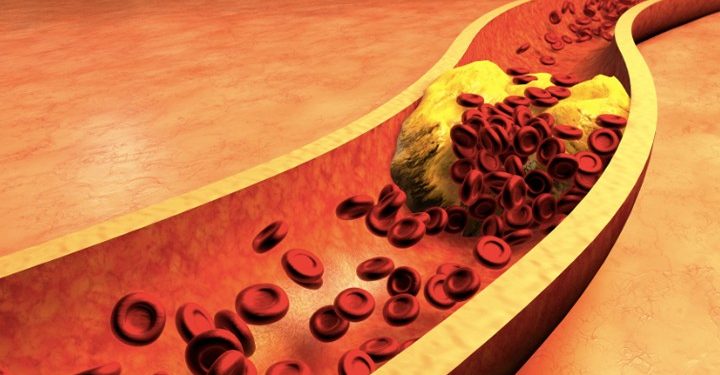 নতুন গবেষণা অনুযায়ী কোলেস্টেরল বা ডিমের উপস্থিতি স্ট্রোকের ঝুঁকি বাড়ায় না