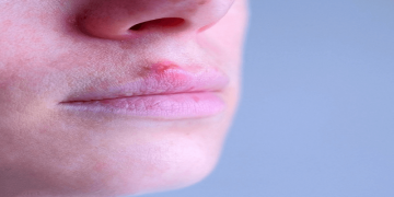 Cold Sores বা জ্বর ঠোসা: কি, কেন হয় ও তার প্রতিকার