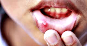 Cold Sores জ্বর ঠোসা