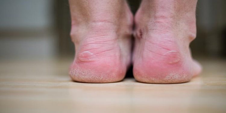 Science Bee Daily Science ফোস্কা