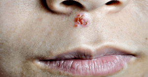Cold Sores জ্বর ঠোসা